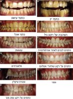 Examples_of_tooth_staining